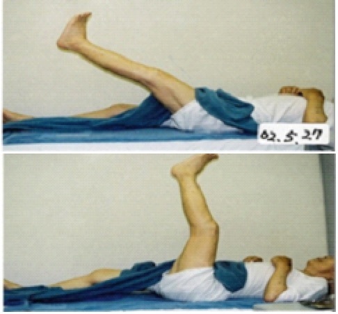 写真２　はり治療後、足の上がり方が改善された様子
